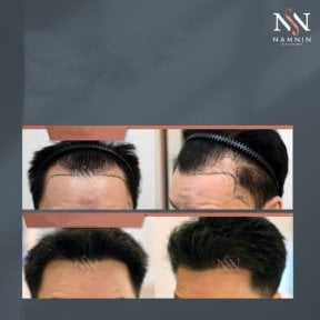 Vorher-nachher-Ergebnisse FUE-Haartransplantation bei Namninforv Clinic, dichtere Haarlinie
