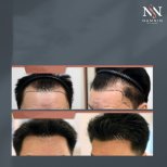 Vorher-nachher-Ergebnisse FUE-Haartransplantation bei Namninforv Clinic, dichtere Haarlinie