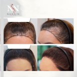 Vorher-nachher-Ergebnisse FUE-Haartransplantation bei Namninforv Clinic, dichtere Haarlinie