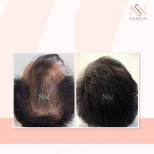 Vorher-nachher-Ergebnis FUE-Haartransplantation bei Namninforv Clinic, dichteres Haar