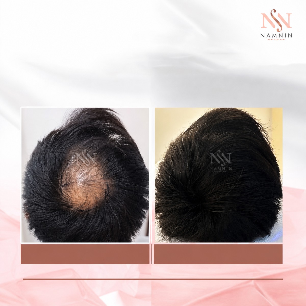 نتائج زراعة الشعر FUE قبل وبعد في عيادة Namninforv، كثافة شعر محسنة