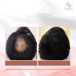 Vorher-nachher-Ergebnisse FUE-Haartransplantation bei Namninforv Clinic, dichteres Haar