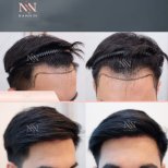Vorher-nachher-Ergebnisse FUE-Haartransplantation bei Namninforv Clinic, Haaransatz restauriert