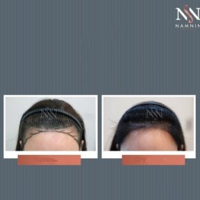 Vorher-nachher FUE-Haartransplantation bei Namninforv Clinic, verbesserte Haardichte
