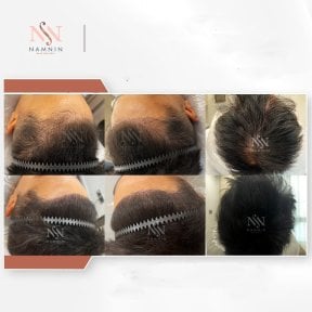 Vorher-nachher-Ergebnisse FUE-Haartransplantation bei Namninforv Clinic, dichteres Haar
