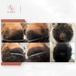 Vorher-nachher-Ergebnisse FUE-Haartransplantation bei Namninforv Clinic, dichteres Haar