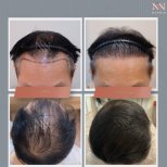 Vorher-nachher-Ergebnis FUE-Haartransplantation bei Namninforv Clinic, dichteres Haar