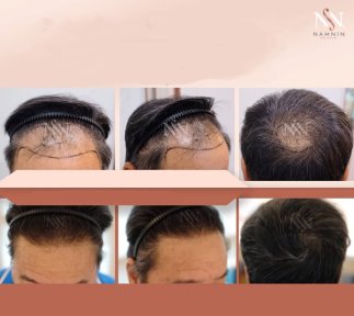 Vorher-nachher-Ergebnisse FUE-Haartransplantation bei Namninforv Clinic, dichteres Haar