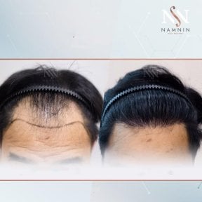 Vorher-nachher-Ergebnisse FUE-Haartransplantation bei Namninforv Clinic, dichtere Haarlinie