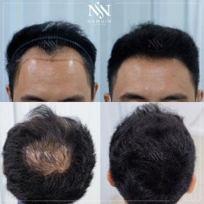 Vorher-nachher-Ergebnis FUE-Haartransplantation bei Namninforv Clinic, mehr Haardichte