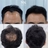 Vorher-nachher-Ergebnis FUE-Haartransplantation bei Namninforv Clinic, mehr Haardichte