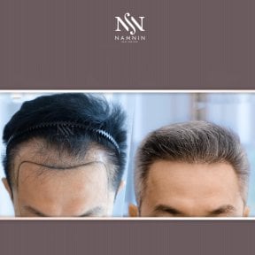 Vorher-nachher-Ergebnis FUE-Haartransplantation bei Namninforv Clinic, dichtere Haarlinie