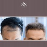 Vorher-nachher-Ergebnis FUE-Haartransplantation bei Namninforv Clinic, dichtere Haarlinie