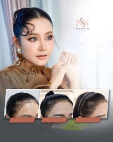 FUE-Haartransplantation Vorher-Nachher-Ergebnisse bei Namninforv Clinic, dichtere Haarlinie