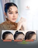 FUE-Haartransplantation Vorher-Nachher-Ergebnisse bei Namninforv Clinic, dichtere Haarlinie