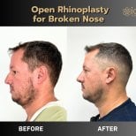 Fotos de antes y después de Rinoplastia tomadas por el Dr.(la Dra.) 