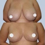 Before and after breast lift results at ID Clinic Bangkok – improved breast shape and lift