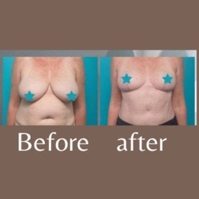 Before and after breast lift results at ID Clinic Bangkok, improved breast contour and firmness