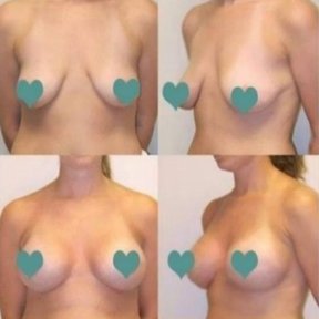 Before and after breast augmentation at ID Clinic Bangkok, enhanced breast shape and volume result