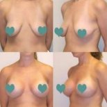 Before and after breast augmentation at ID Clinic Bangkok, enhanced breast shape and volume result