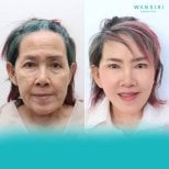 Facelift before and after results at Wansiri Hospital, visible facial rejuvenation effect