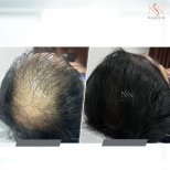 Vorher-nachher-Ergebnis FUE-Haartransplantation bei Namninforv Clinic, dichteres Haar