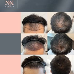Vorher-nachher-Ergebnisse FUE-Haartransplantation bei Namninforv Clinic, dichteres Haar