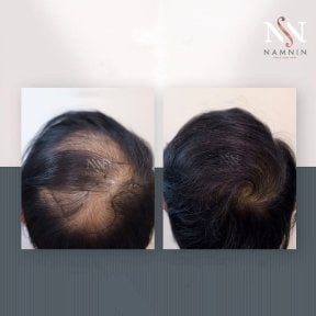 Vorher-nachher-Ergebnis FUE-Haartransplantation bei Namninforv Clinic, dichteres Haar