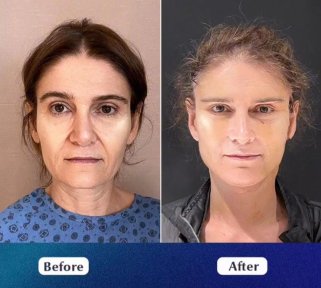 Facelift before and after results at Medipol Mega University Hospital, visible facial rejuvenation