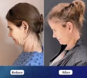 Facelift before and after results at Medipol Mega University Hospital, visible neck lift