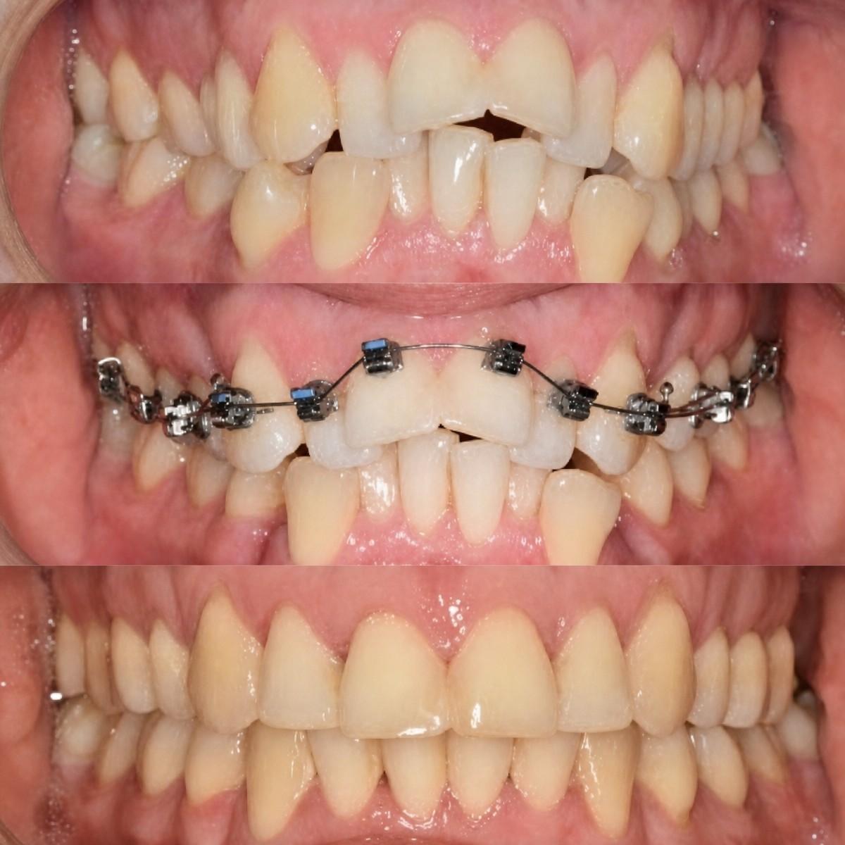 Resultados de ortodoncia antes y después en Smile Centrum, alineación dental y corrección de mordida