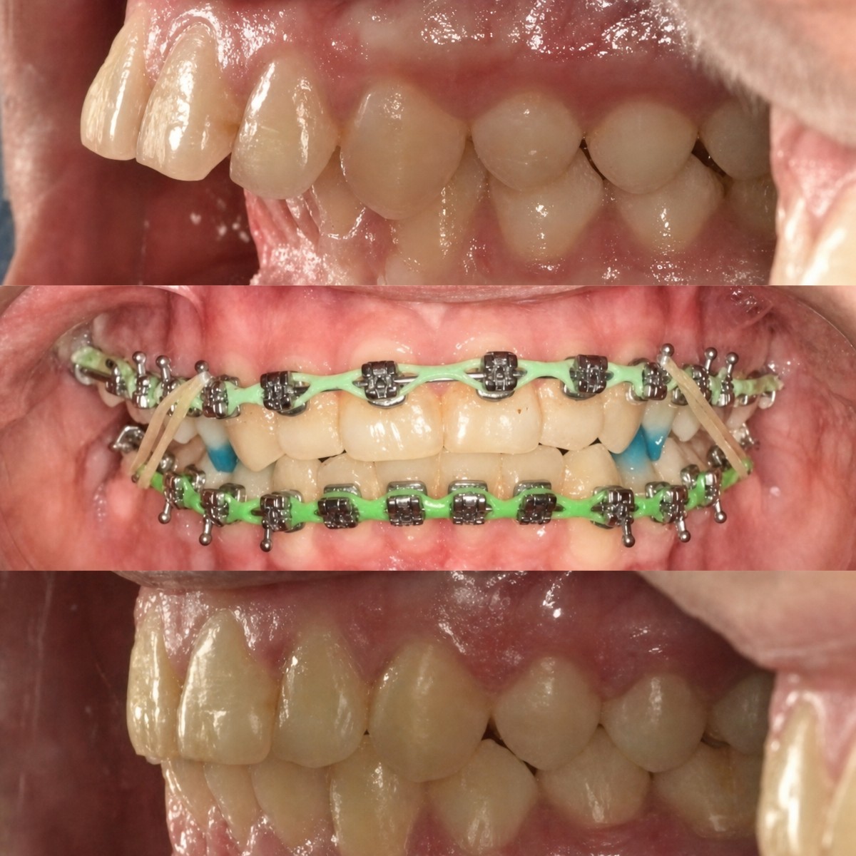 نتائج قبل وبعد تقويم الأسنان في Smile Centrum – تحسين اصطفاف الأسنان وتصحيح العضة