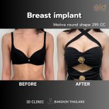 Before and after breast augmentation at ID Clinic Bangkok, Motiva round implants 295cc result