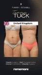 Before and after Tummy tuck photos by Dr.