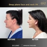 Fotos de antes y después de Liposucción tomadas por el Dr.(la Dra.) 