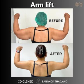Before and after arm lift results at ID Clinic Bangkok showing slimmer, toned upper arms