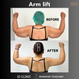 Before and after arm lift results at ID Clinic Bangkok showing slimmer, toned upper arms