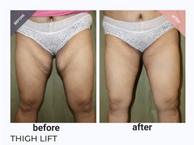 Before and after thigh lift results at ID Clinic Bangkok, improved thigh contour and skin tightness
