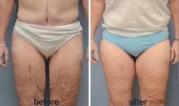 Full body lift before and after results at ID Clinic Bangkok – improved skin tightness and contour