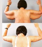 نتائج شد الذراعين (براكيوبلاستي) قبل وبعد في عيادة د. صفا مناف، تحسين شكل الذراع