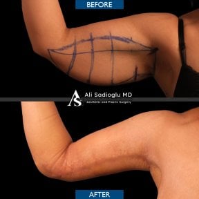 نتائج شد الذراعين قبل وبعد في عيادة Dr. Safa Manav، تحسين شكل الذراع