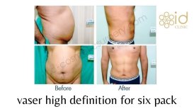 Fotos de antes e depois de Lipoaspiração pelo Dr. 