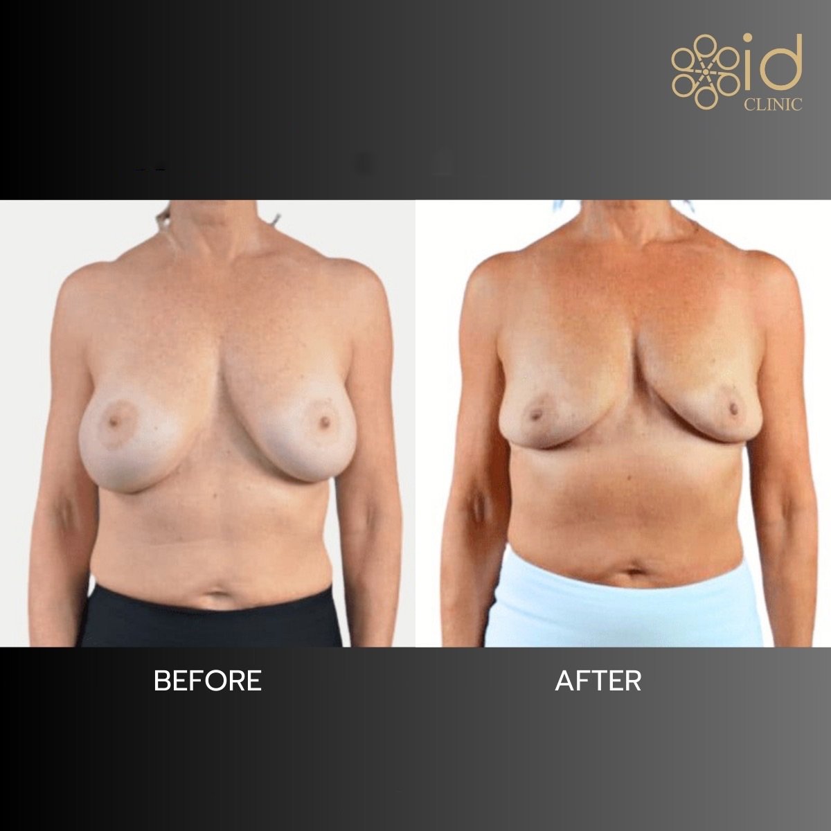 نتائج قبل وبعد إزالة حشوات الثدي في ID Clinic Bangkok، شكل طبيعي للثدي
