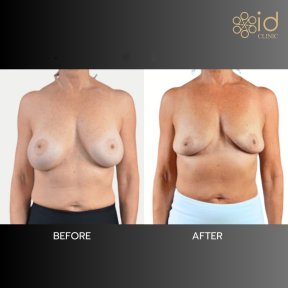 Before and after breast implant removal results at ID Clinic Bangkok, natural breast contour