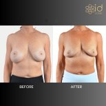 Before and after breast implant removal results at ID Clinic Bangkok, natural breast contour