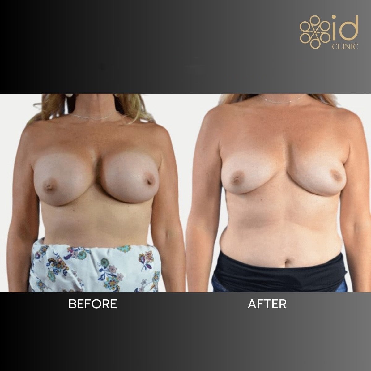نتائج قبل وبعد إزالة حشوات الثدي في ID Clinic Bangkok، شكل طبيعي للثدي