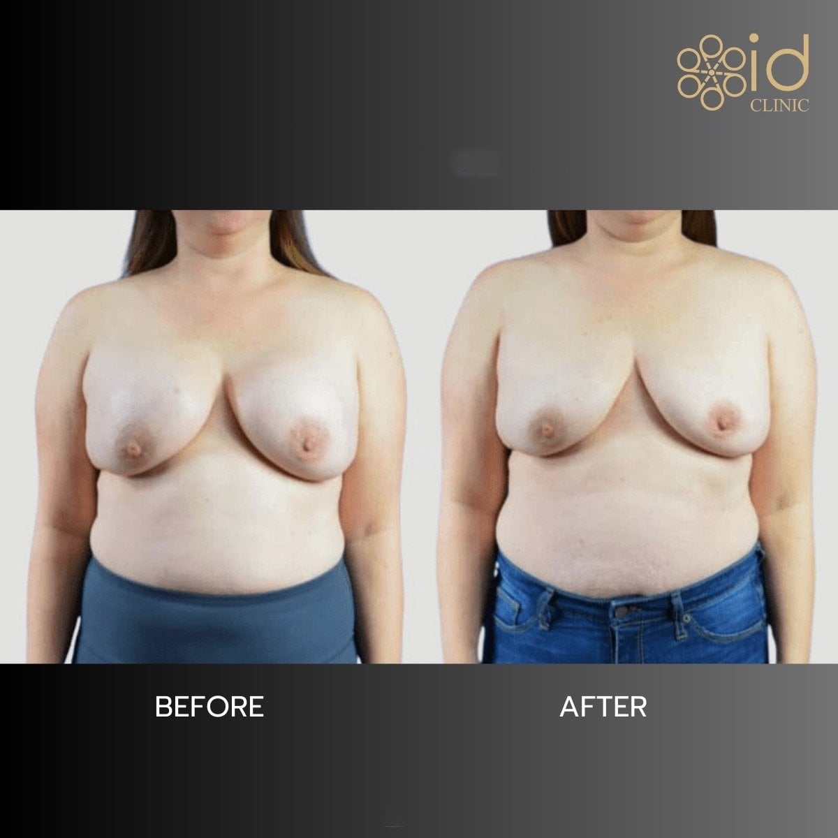 نتائج قبل وبعد إزالة حشوات الثدي في ID Clinic Bangkok، شكل طبيعي للثدي