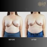 Before and after breast implant removal results at ID Clinic Bangkok, natural breast contour