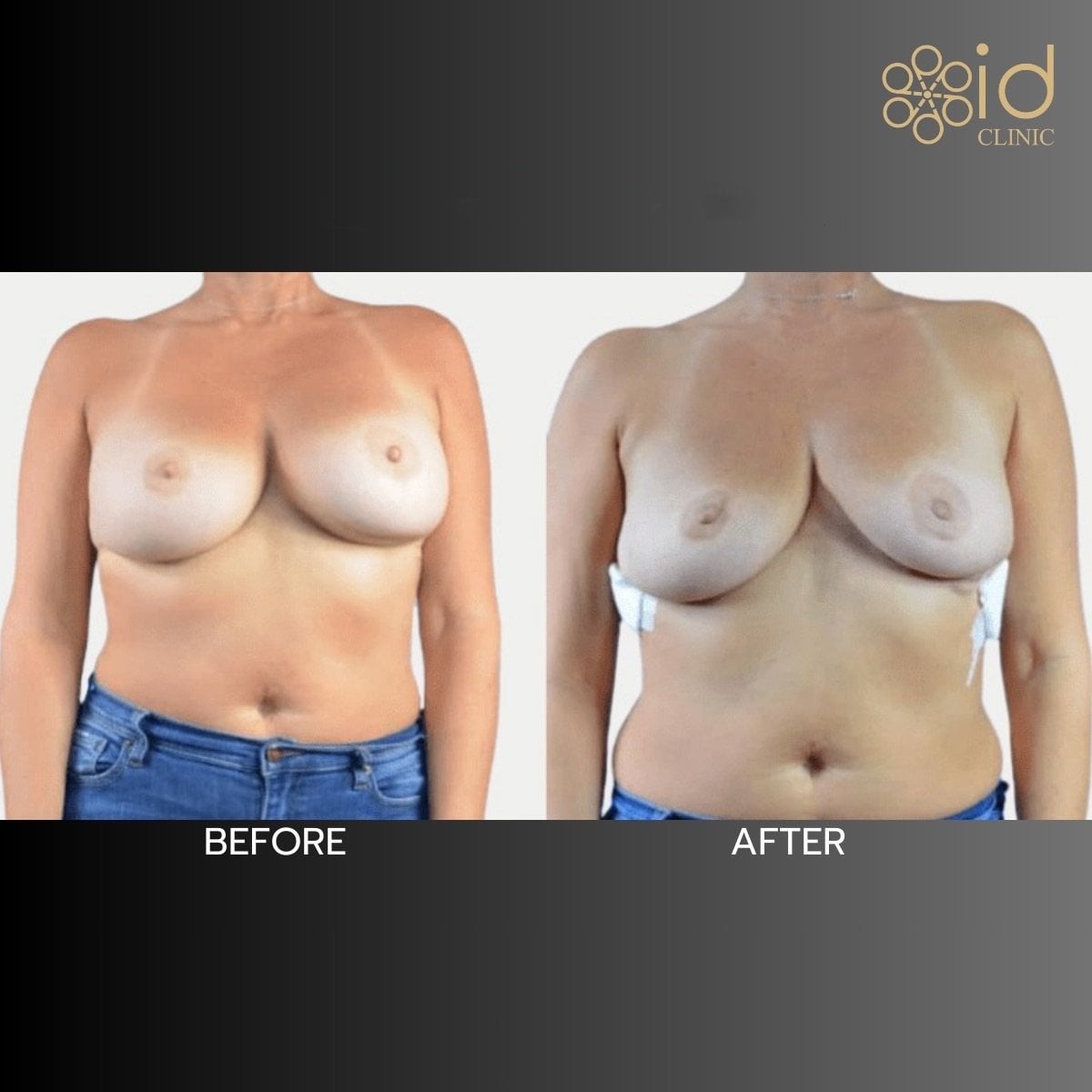 نتائج قبل وبعد إزالة حشوات الثدي في ID Clinic Bangkok، شكل طبيعي للثدي