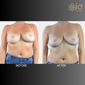 Before and after breast implant removal results at ID Clinic Bangkok, natural breast contour
